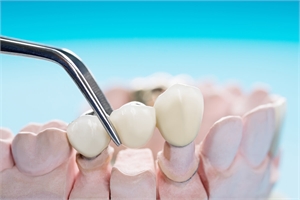 Benefits and Considerations of Fixed Dental Bridges