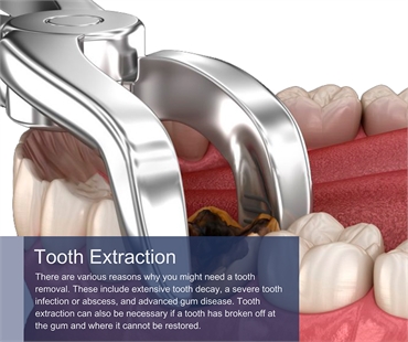 Tooth Extraction in New York