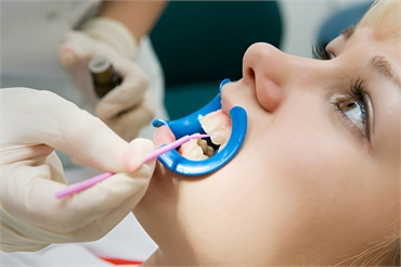 6 Ways to Choose the Right Dental Sealant
