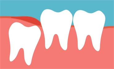 Wisdom Teeth Signs Symptoms Treatment