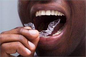 Facts about Invisalign Treatment