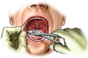 Surgical Extraction of Wisdom Teeth