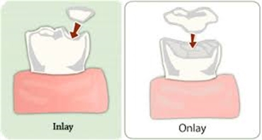 Difference Between And Inlay And An Onlay
