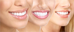 Your Dental Benefits What You Should Know