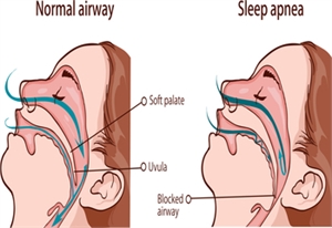 How to rectify Sleep Apnea and What is the treatment for it