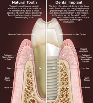 Dental Implants in Roswell Georgia