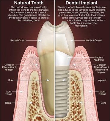 Dental Implant Dentistry at TruCare Dentistry Roswell