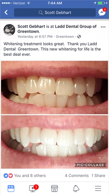 Teeth Whitening Love
