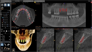 Tooth Implant Process