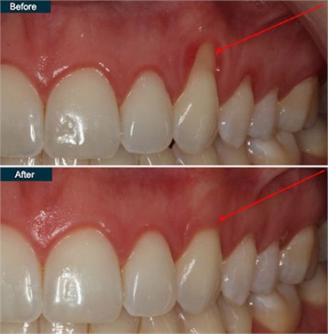 RECEDING GUMS TREATMENT IN NYC