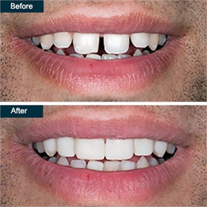 Dental Bonding Cosmetic Teeth Bonding