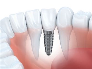 Dental Implants vs. Root Canal