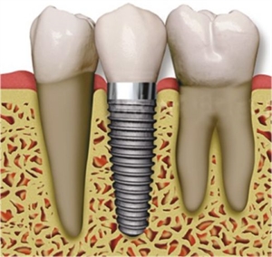 Dental implant is a small titanium tooth root replacement. 