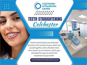 Teeth Straightening in Colchester