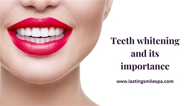 What Is Professional Teeth Whitening