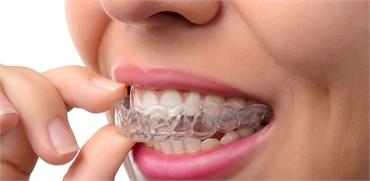 Going for Invisalign. Check These Facts before You Get One