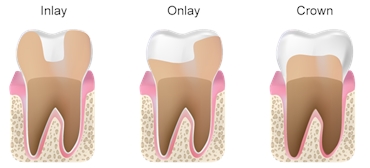 Dental Inlays and Onlays. Are They Better Than Crowns
