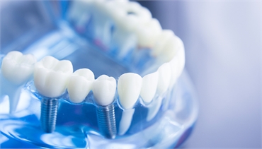 Why You Should Avail Dental Implants For Your Teeth