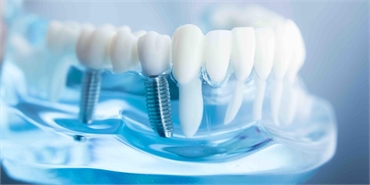 A Complete Guide To Help You Know About Dental Implant Surgery