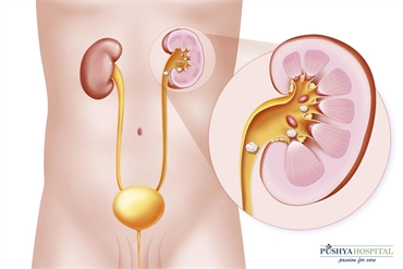 Kidney Stone Causes Symptoms and Treatment For The Urologic Patient