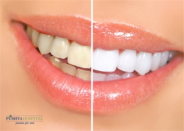 Should I Seek for Teeth Whitening Treatment Is It Safe For Me