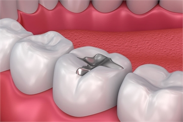 A Complete Guide to Dental Fillings Advantages and Disadvantages