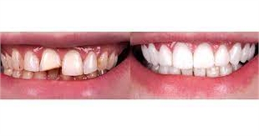 Exploring Dental Restoration Finding Your Perfect Smile Solution