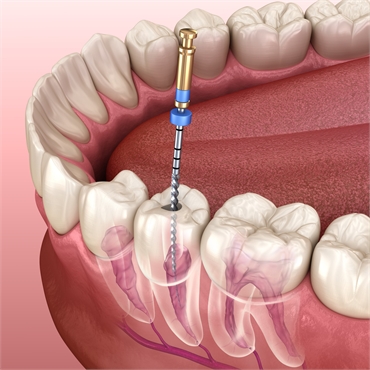 Demystifying Root Canals Understanding Procedure Duration and Pain Management