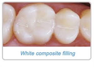 What are white colored fillings