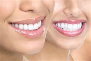 Know how long do porcelain crowns last on front teeth