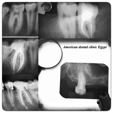 Endodontic treatment 
