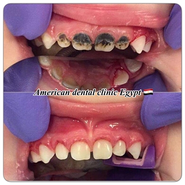Restoration child teeth 