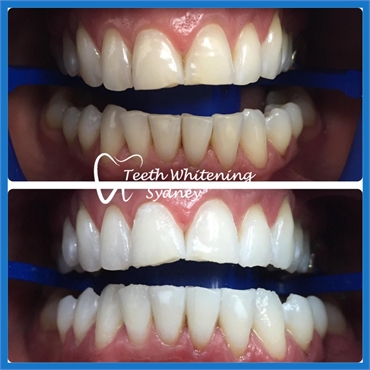 Teeth Whitening Transformation