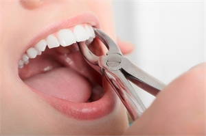 Tooth Extraction and Facial Aesthetics