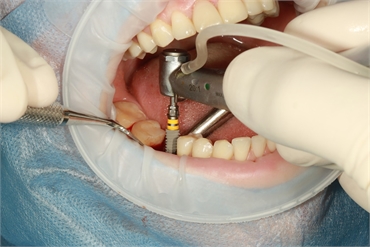 Making a Choice to Get All on 4 Dental Implants