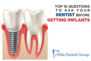 Top 10 Questions to Ask Your Dentist Before Getting Implants