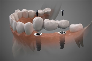 pros and cons of implant supported bridges