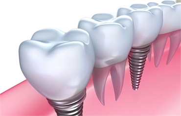 Dental-Implants-in-Sydney