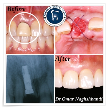 Dental implant by dr.omer naghshbandi american dental clinic erbil 