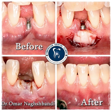 Dental implant and gum surgery by dr.omer naghsbandi American dental clinic erbil