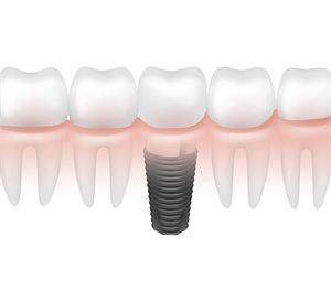 metal dental implant between other teeth in gum side 