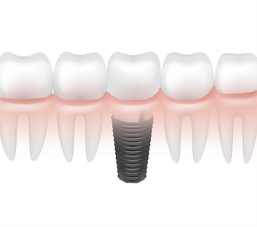 All on 4 Dental Implants and Bone Grafting Jawbone Loss and Resorption