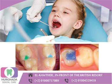 colored fillings for kids