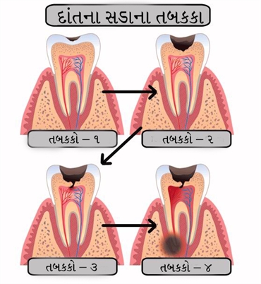 Dental Caries in Gujarati Language