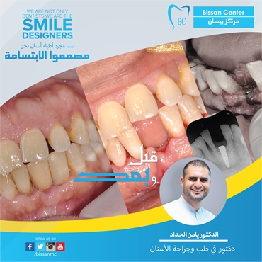 Teeth Implant - Complicated Surgery 