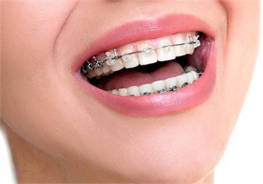 Regenerate smile with full mouth reconstruction