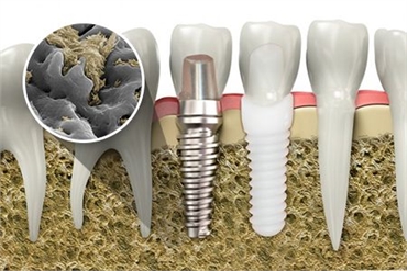 What is Osseointegration