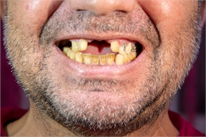 Gum Disease Treatment for Drug Addicts