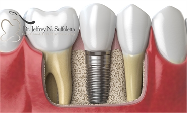 You Have Same Day Dental Implant Options
