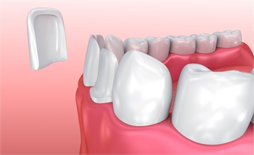 Replacing or Fixing a Front Chipped Tooth. Are Dental Veneers Right for You